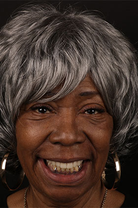 Healthy and symmetrical smile achieved through gum recession correction with grafting.